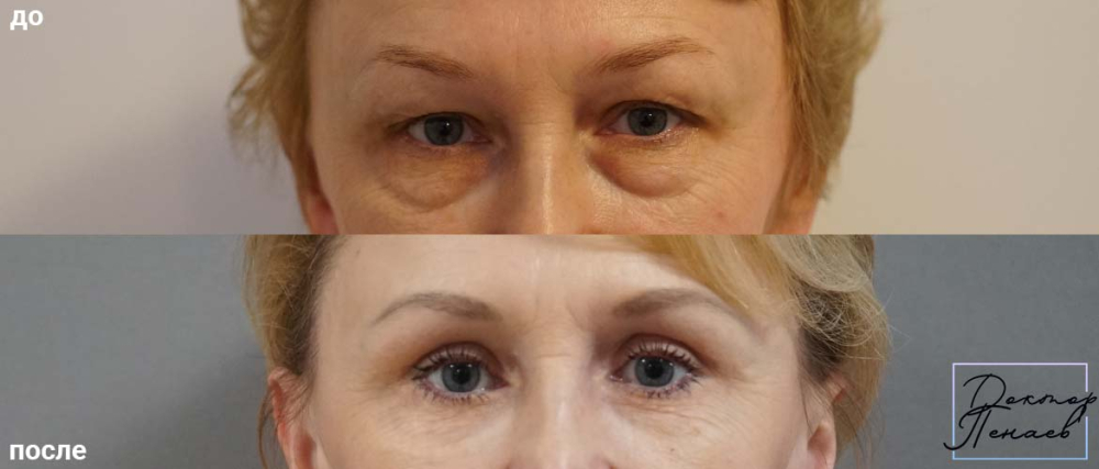 Фото пациентки до и после круговой блефаропластики у пластического хирурга Арслана Пенаева