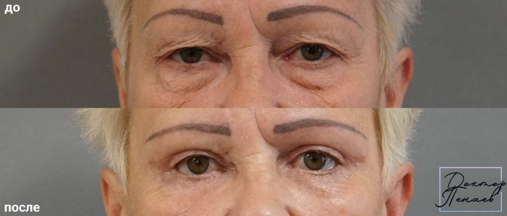 Фото пациентки до и после круговой блефаропластики у доктора Арслана Пенаева
