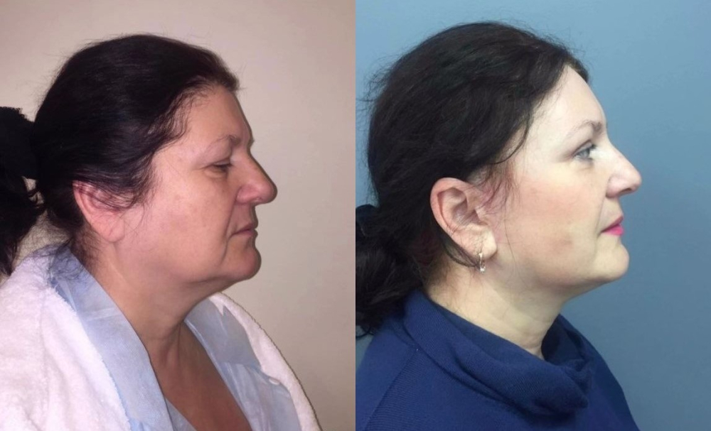 Пациентка пластического хирурга Светланы Пшонкиной до и после омолаживающей операции лица