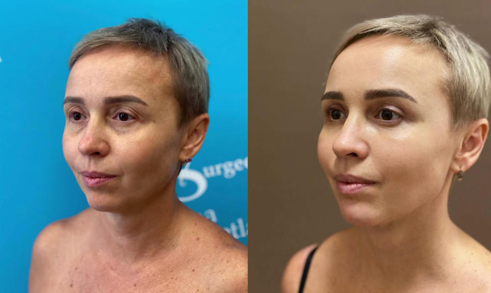 Пациентка пластического хирурга Светланы Пшонкиной до и после эндоскопической подтяжки лица.