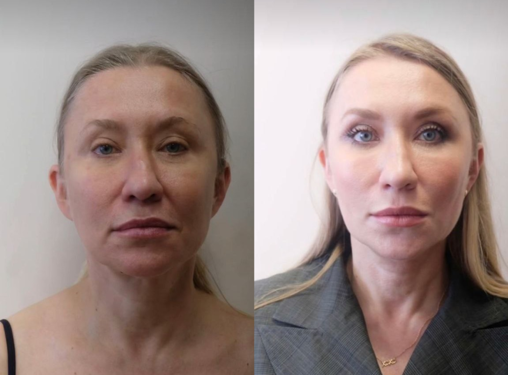 Пациентка пластического хирурга Светланы Пшонкиной до и после комплексного омоложения