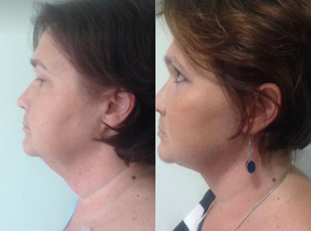 Пациентка пластического хирурга Светланы Пшонкиной до и после подтяжки лица и блефаропластики.