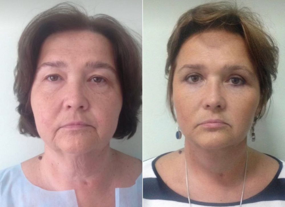 Пациентка пластического хирурга Светланы Пшонкиной до и после подтяжки лица и блефаропластики.