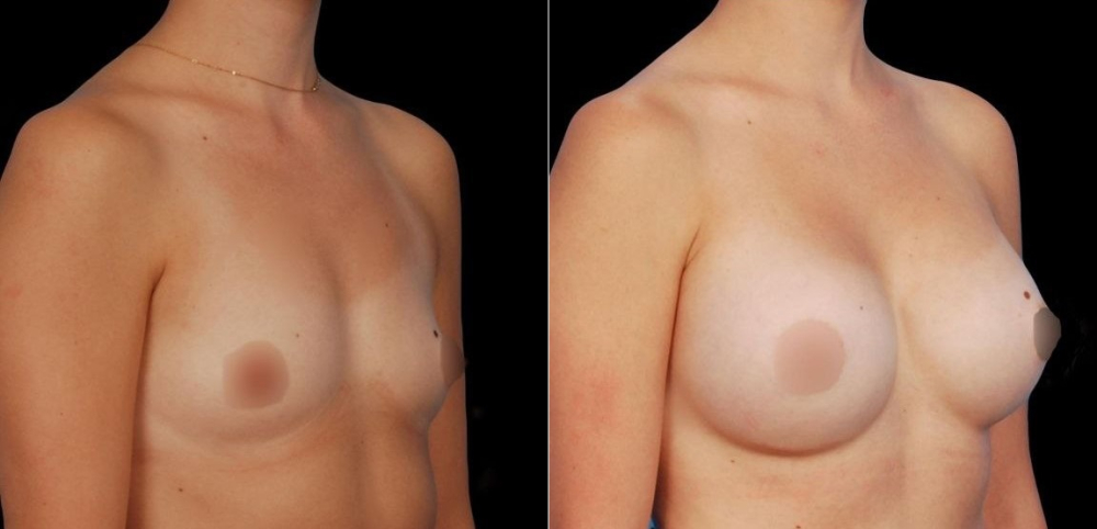 Пациентка доктора Гукаса Миракяна. Фото до и после увеличения груди имплантатами