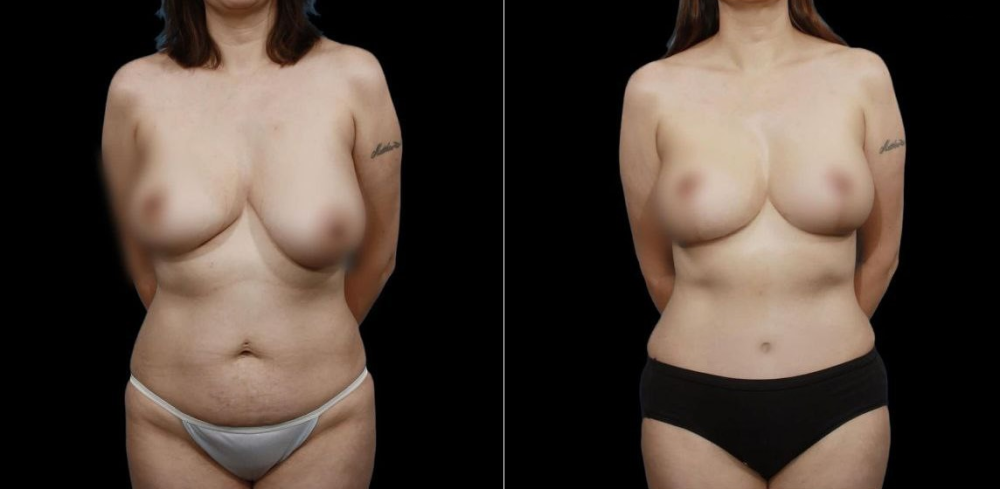 Пациентка пластического хирурга Гукаса Миракяна.  Ей была выполнена абдоминопластика и якорная подтяжка груди