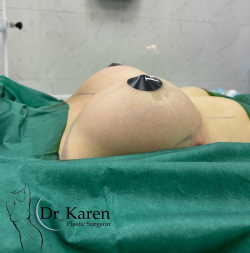  Пациентка пластического хирурга Карена Пайтяна. Фото после увеличения груди