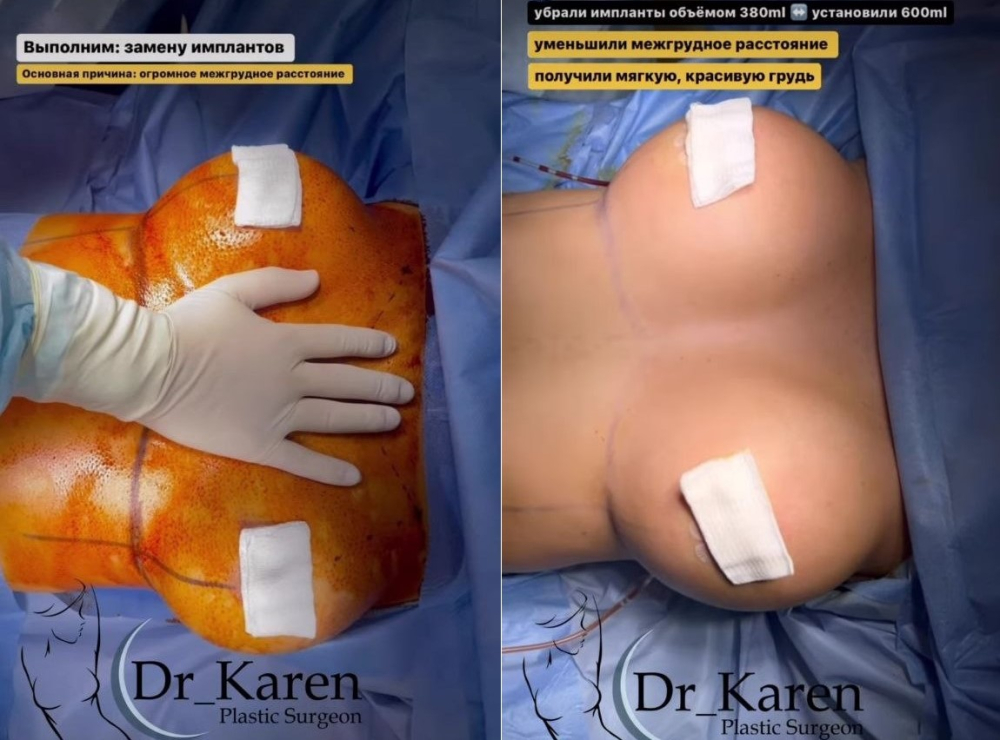 Пациентка пластического хирурга Карена Пайтяна до и после реэндопротезирования груди