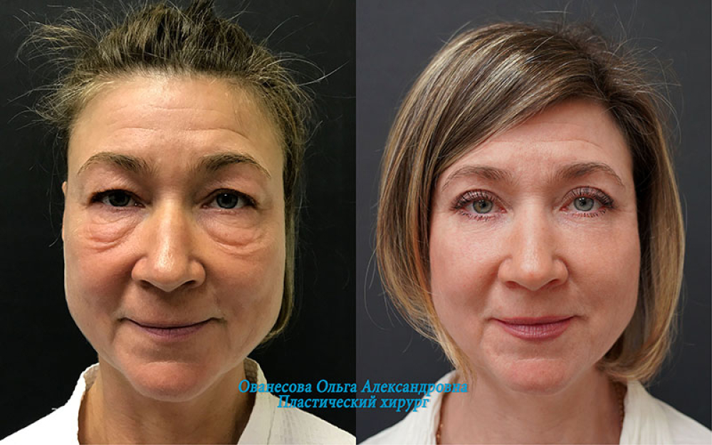 Пациентка доктора Ольги Ованесовой. Женщине была выполнена круговая блефаропластика и коррекция малярных образований