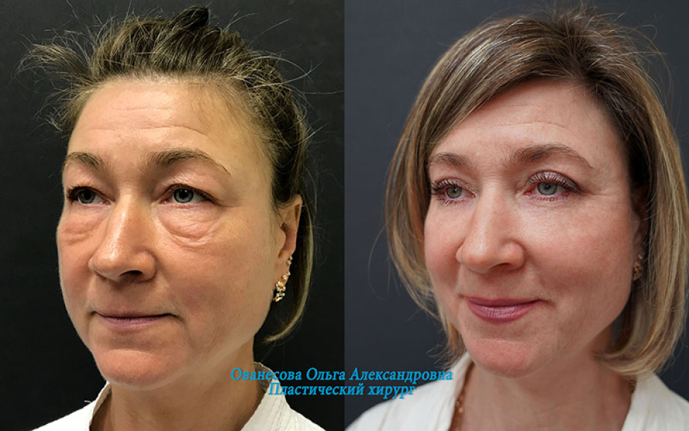 Пациентка доктора Ольги Ованесовой. Женщине была выполнена круговая блефаропластика и коррекция малярных образований