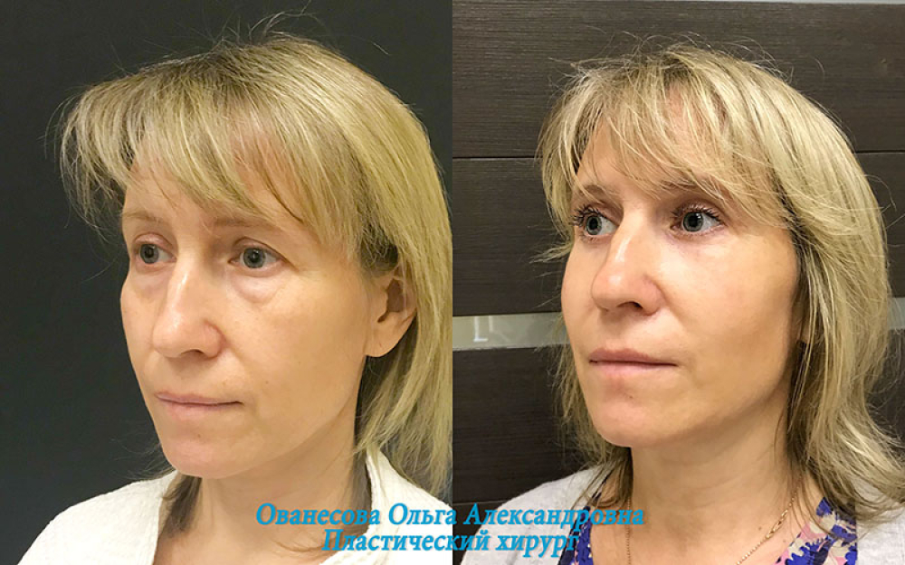 Пациентка доктора Ованесовой до и после круговой блефаропластики и липомоделирования малярной области