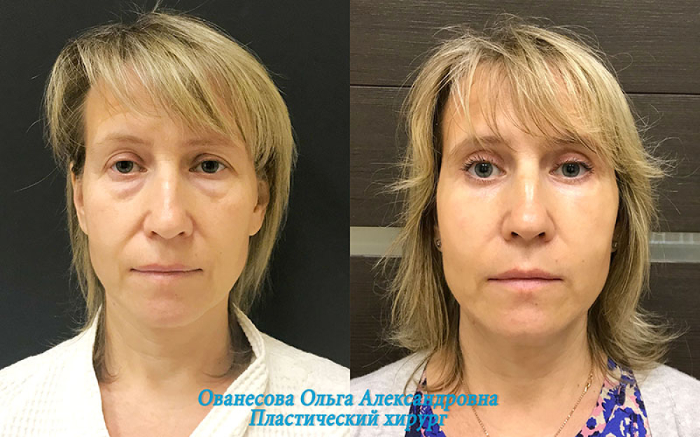 Пациентка доктора Ованесовой до и после круговой блефаропластики и липомоделирования малярной области.