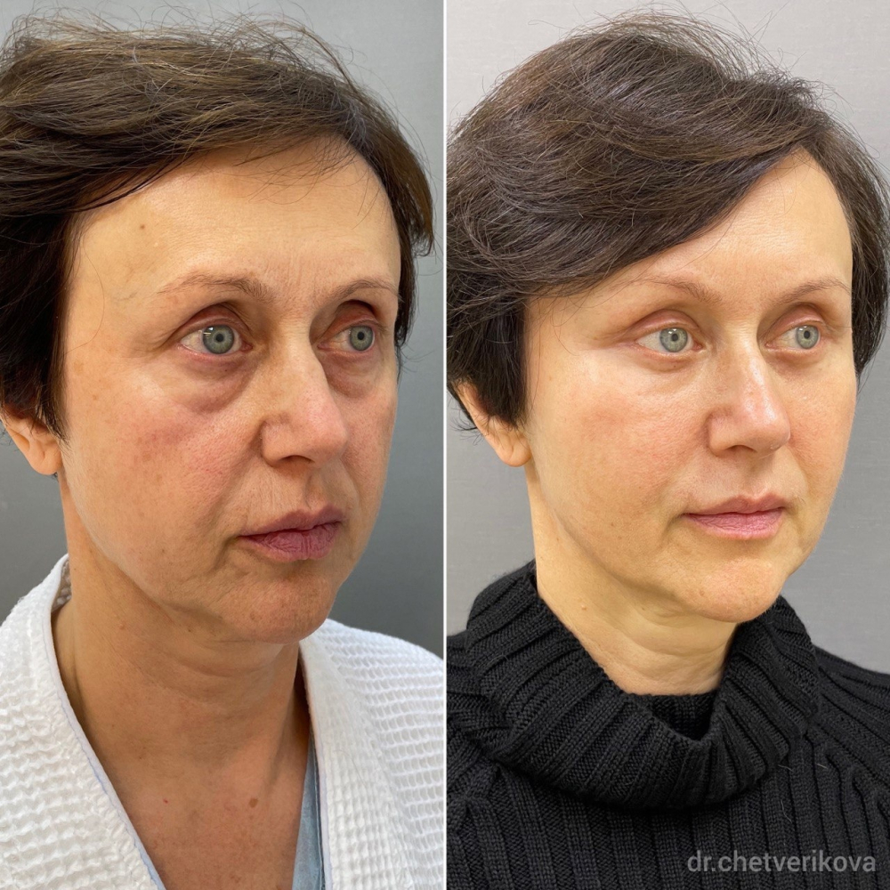 Пациентка пластического хирурга Марины Четвериковой до и после эндоскопического омоложения лица