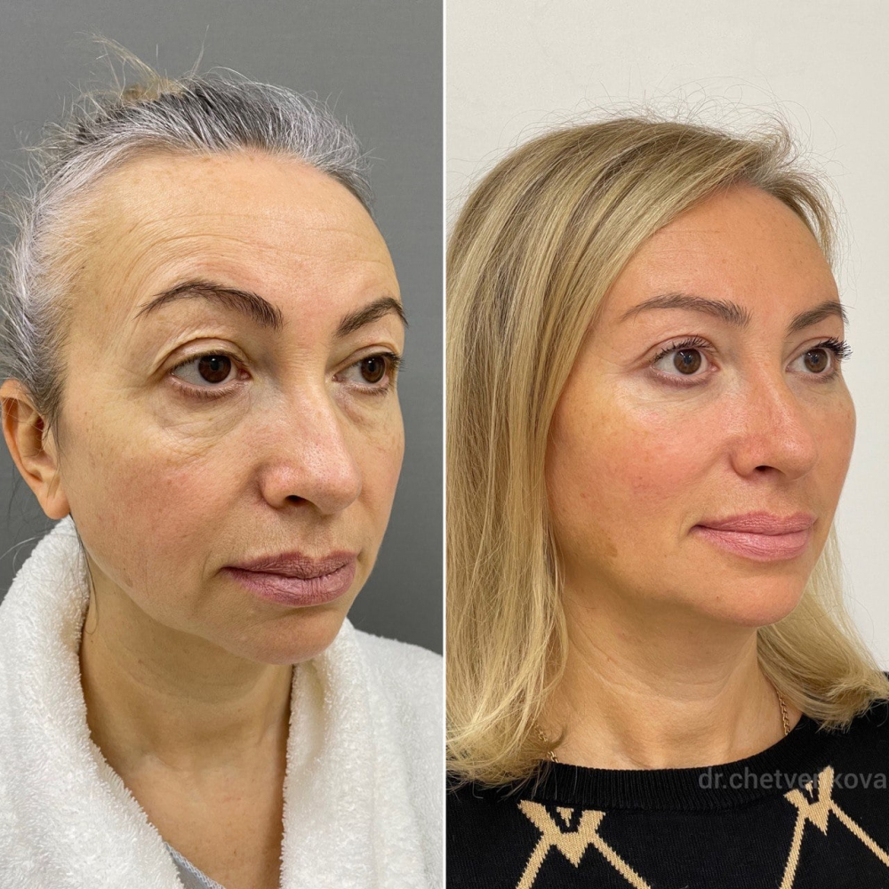 Пациентка пластического хирурга Марины Четвериковой до и после эндоскопической подтяжки верхней и средней трети лица и верхней блефаропластики