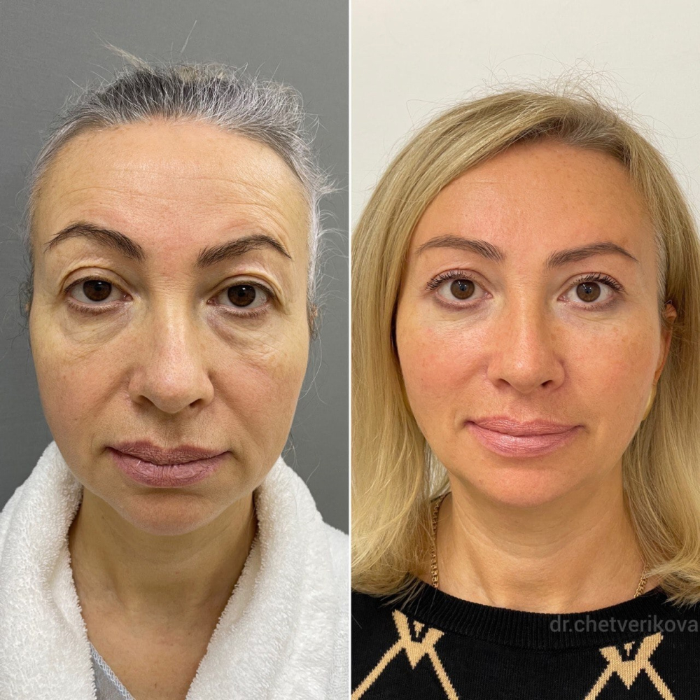 Пациентка пластического хирурга Марины Четвериковой до и после комплексного омоложения лица