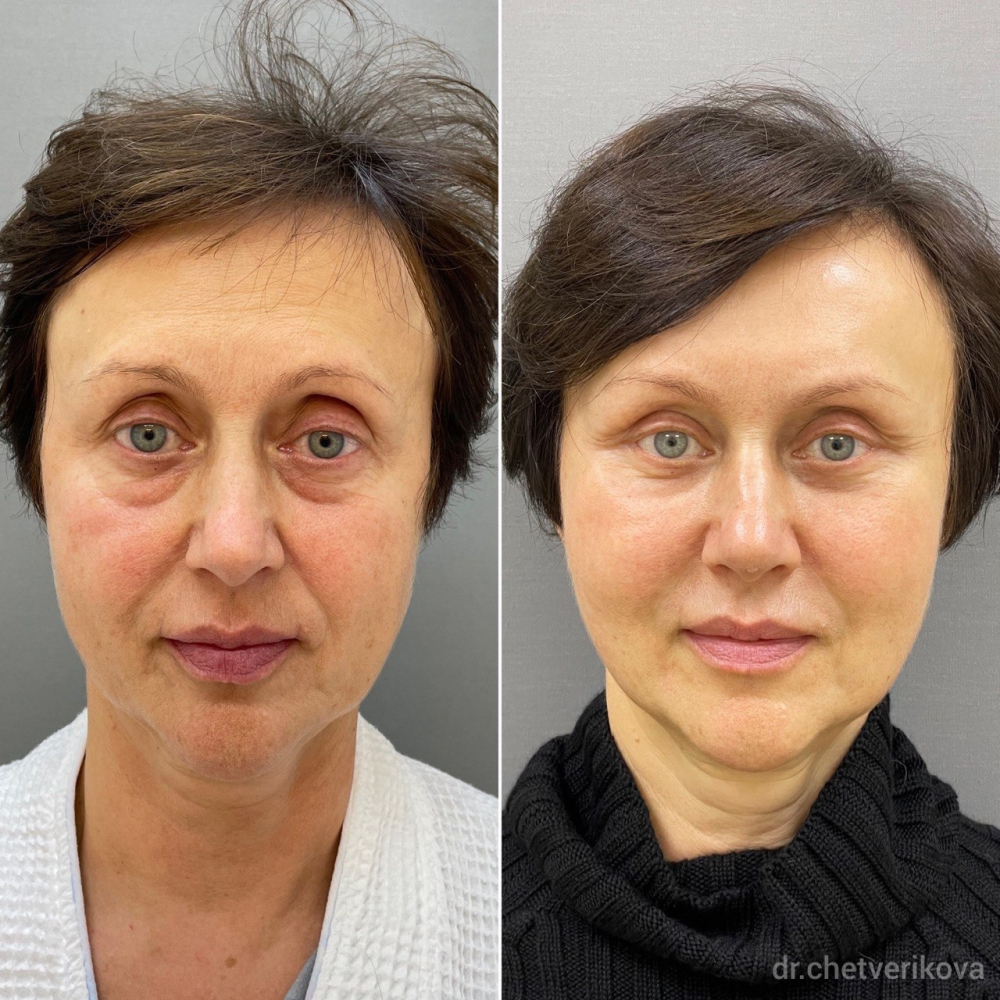 Пациентка пластического хирурга Марины Четвериковой до и после эндоскопического омоложения.