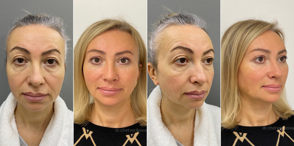 Пациентка доктора Четвериковой до и через 7 месяцев после подтяжки лица