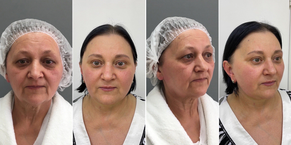 Пациентка доктора Четвериковой до и через 3 года после подтяжки лица