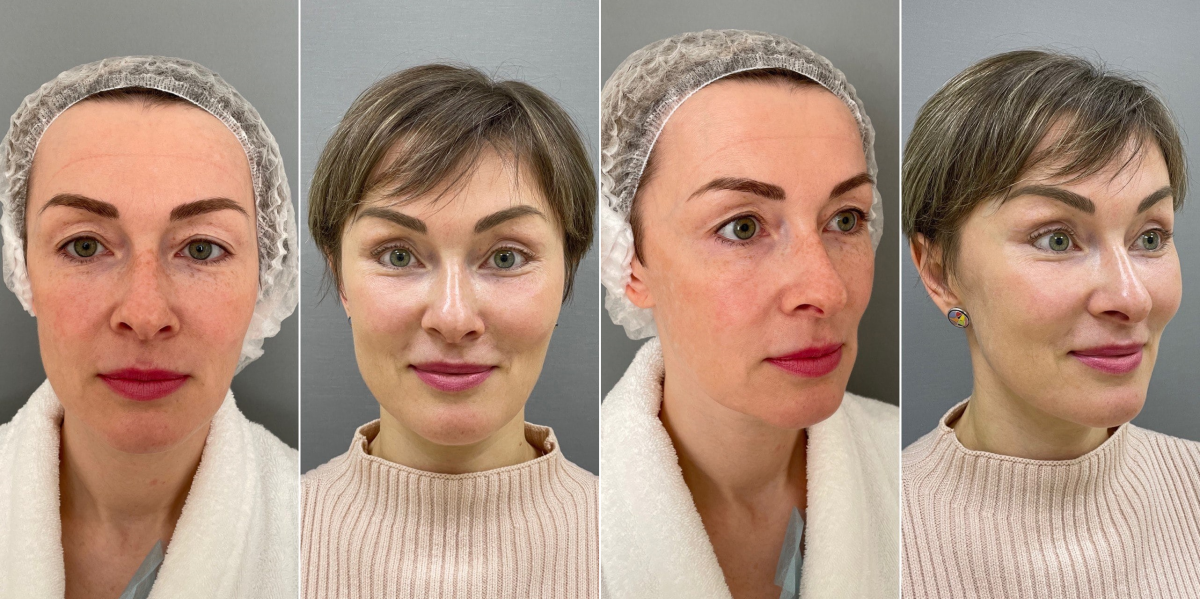 Пациентка доктора Четвериковой до и через 3 месяца после подтяжки