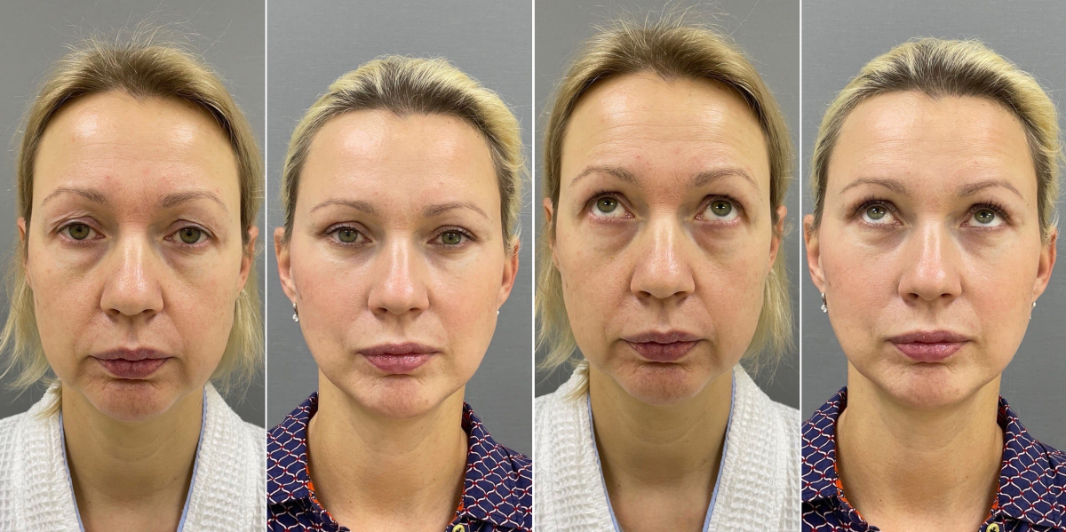 Пациентка доктора Четвериковой до и через 6 месяцев после операции