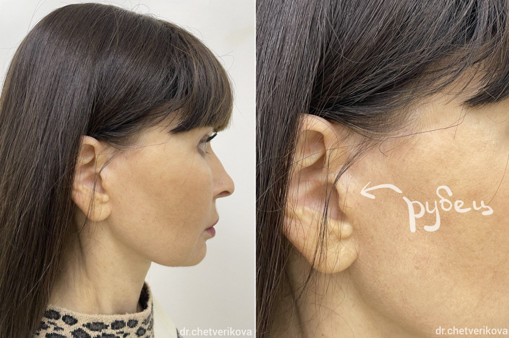 Пациентка пластического хирурга Марины Четвериковой