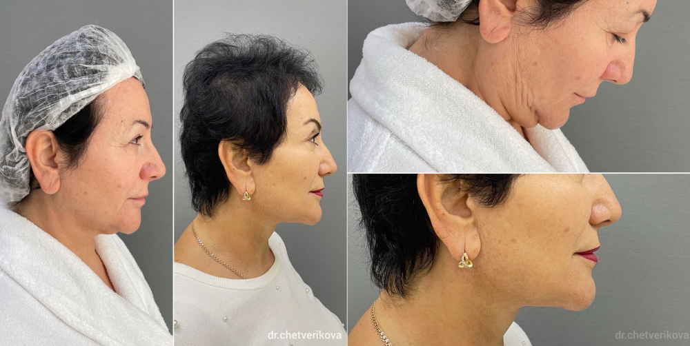 Пациентка пластического хирурга Марины Четвериковой до и после комплексной подтяжки лица и шеи.