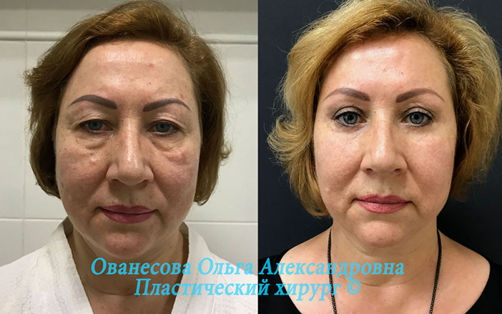 Пациентка доктора Ольги Ованесовой до и после пластики лица