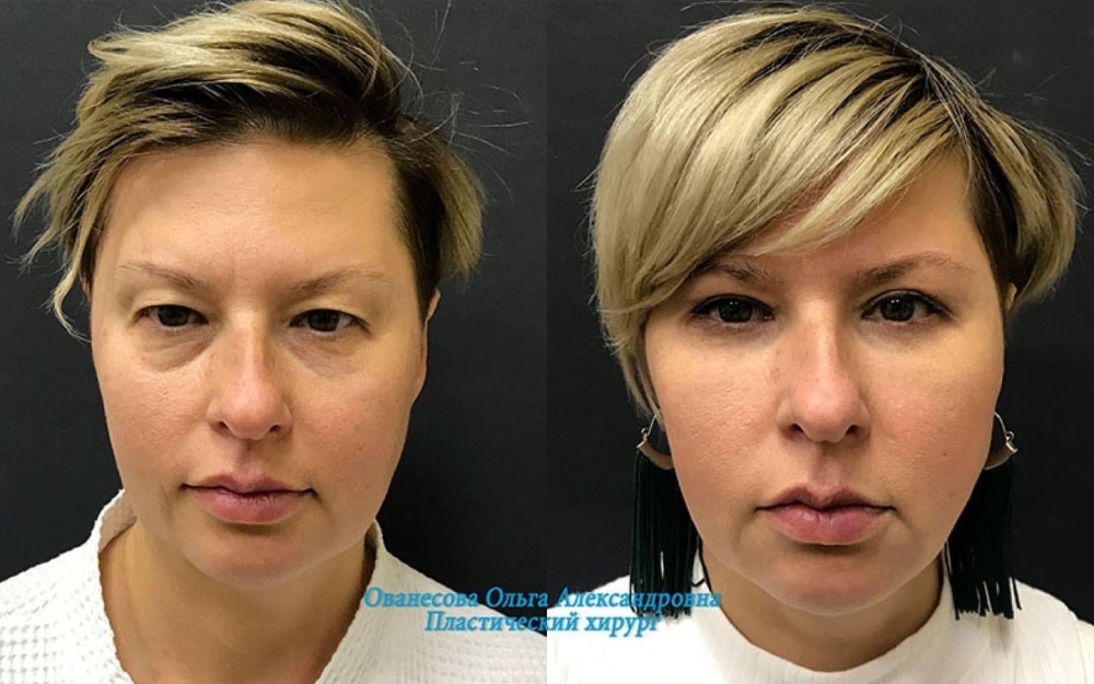 Пациентка доктора Ольги Ованесовой. Женщине была выполнена круговая блефаропластика и удаление малярных образований
