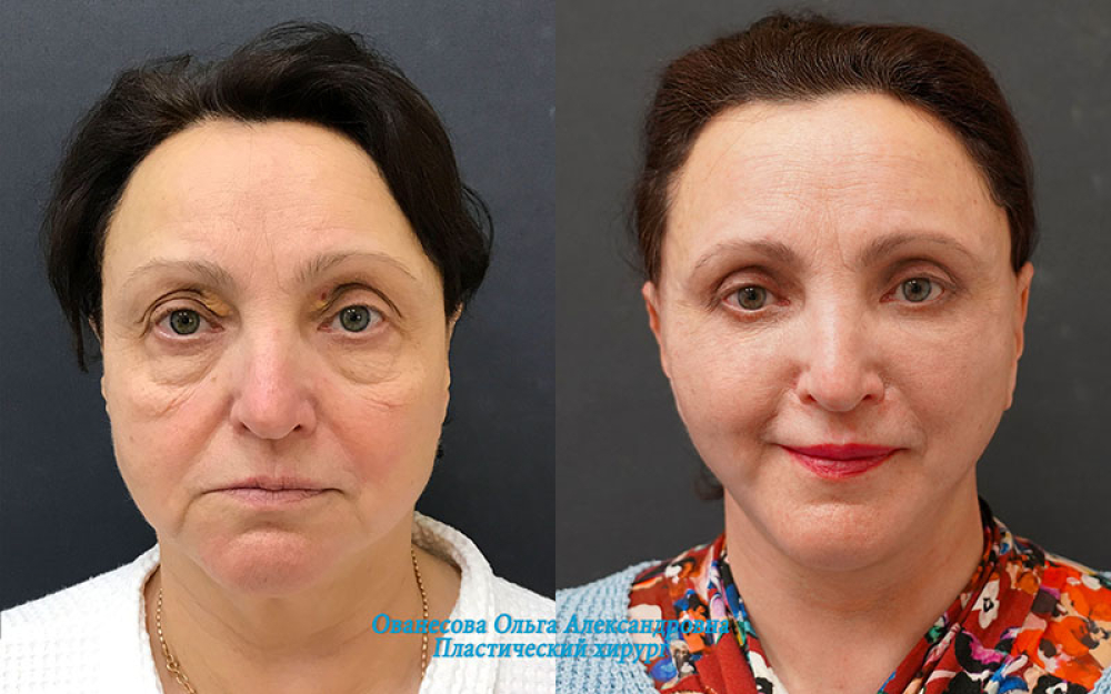 Пациентка доктора Ольги Ованесовой. Женщине было выполнено комплексное омоложение лица и шеи и удаление малярных образований