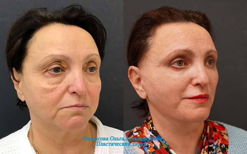 Пациентка доктора Ольги Ованесовой. Женщине было выполнено комплексное омоложение лица и шеи и удаление малярных образований