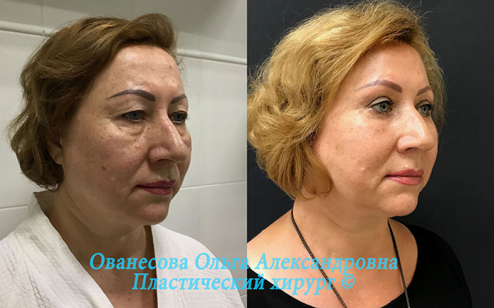 Пациентка доктора Ольги Ованесовой до и после блефаропластики и липомоделирования малярной области