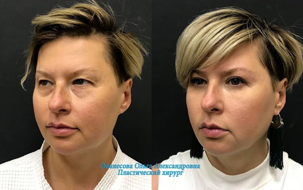 Пациентка доктора Ольги Ованесовой. Женщине была выполнена круговая блефаропластика и удаление малярных образований