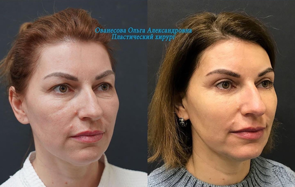 Пациентка доктора Ольги Ованесовой. Женщине была выполнена круговая блефаропластика и липомоделирование малярной области