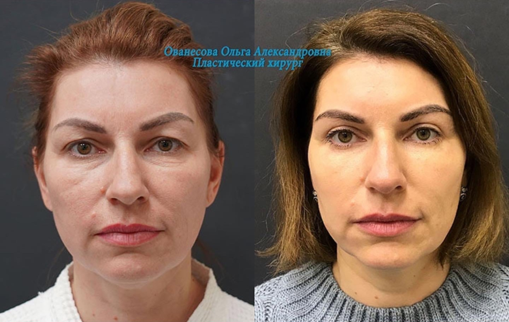 Пациентка доктора Ольги Ованесовой. Женщине была выполнена круговая блефаропластика и липомоделирование малярной области