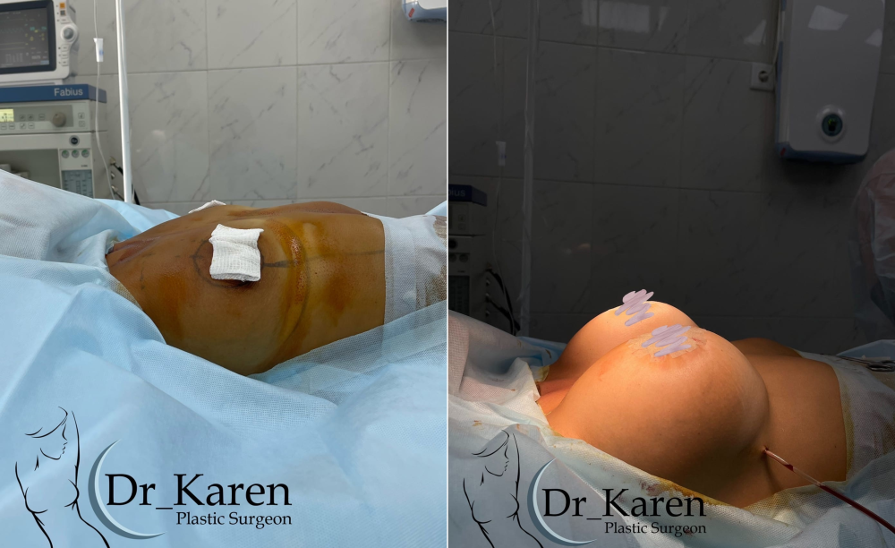 Пациентка пластического хирурга Карена Пайтяна. Женщине выполнили увеличение груди имплантами 450ml с подтяжкой вокруг ареол.