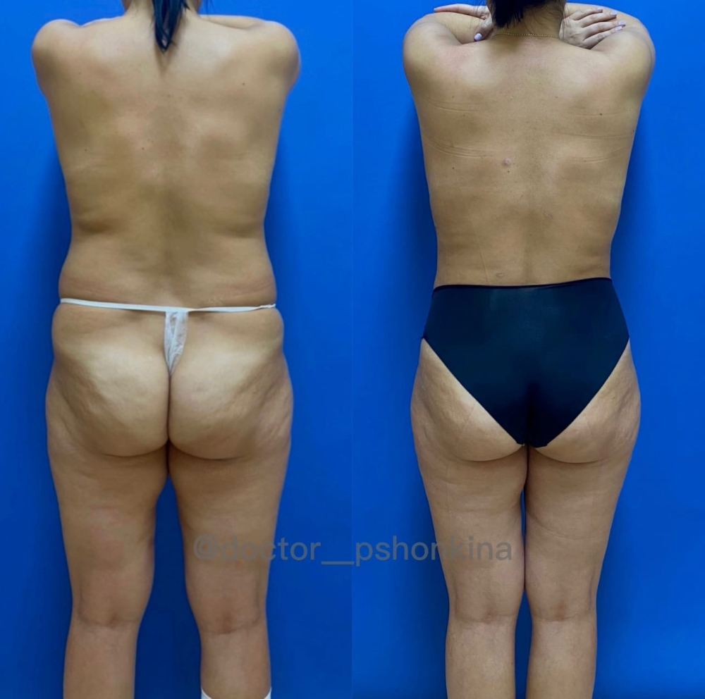 Пациентка доктора Светланы Пшонкиной до и после радиочастотной липосакции Боди Тайт.