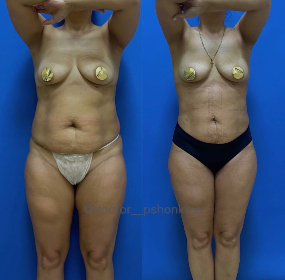 Пациентка пластического хирурга Светланы Пшонкиной до и после радиочастотной липосакции Боди Тайт.