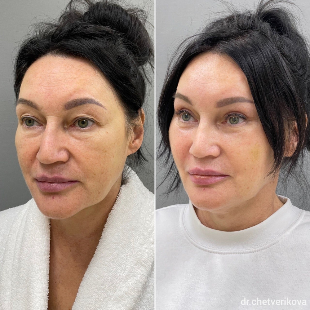 Пациентка пластического хирурга Марины Четвериковой. Фото до и через 1,5 месяца после комплексной омолаживающей операции.