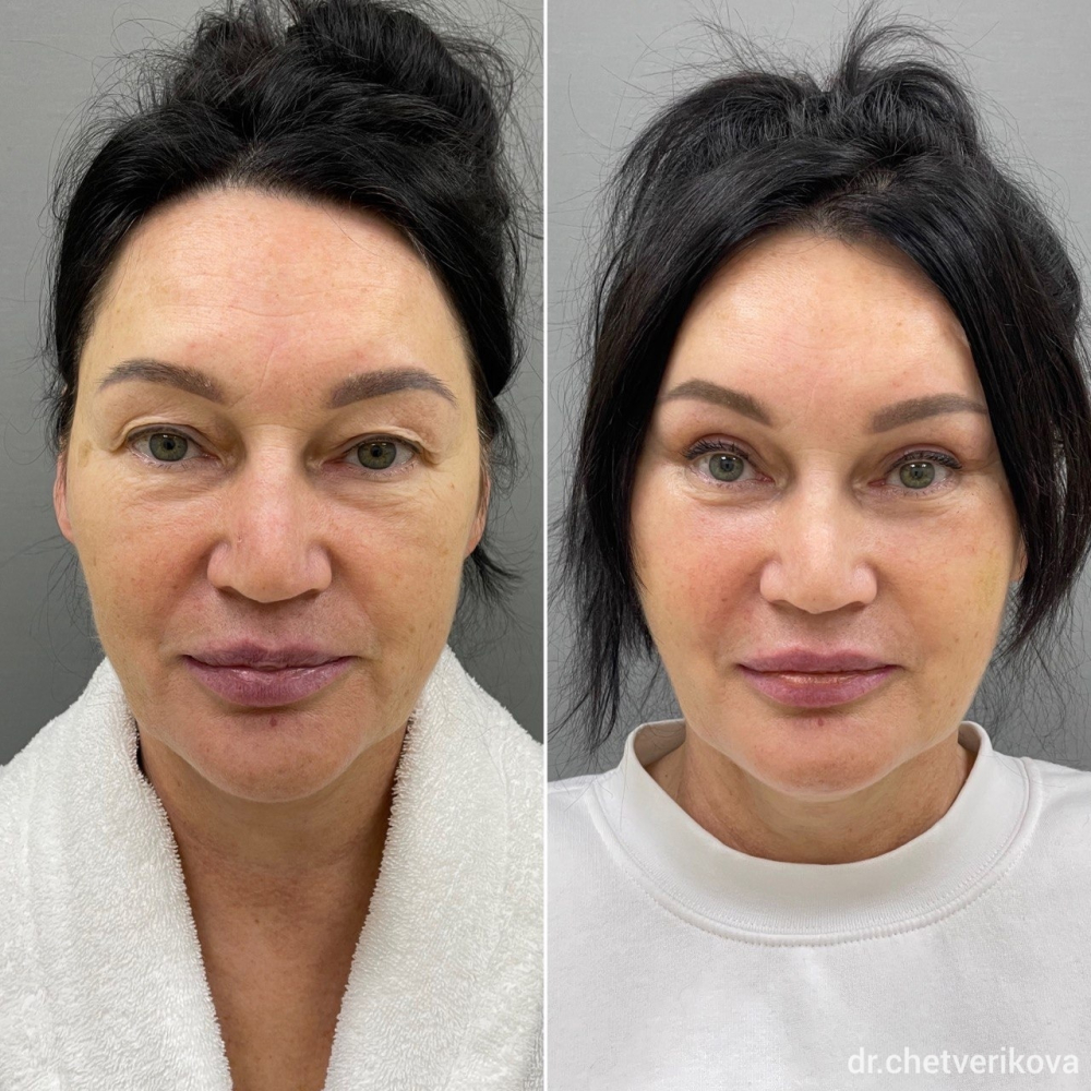 Пациентка пластического хирурга Марины Четвериковой. Фото до и через 1,5 месяца после комплексной омолаживающей операции.