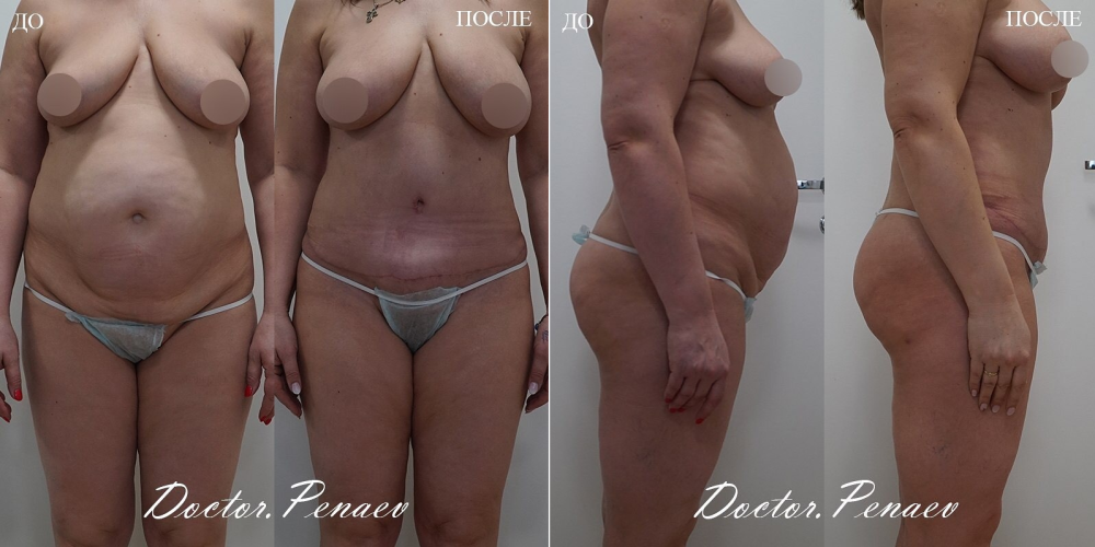 Пациентка (48 лет) доктора Арслана Пенаева до и после липоабдоминопластики