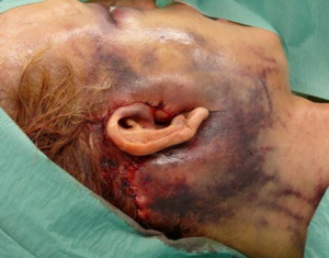 Гематома после подтяжки лица