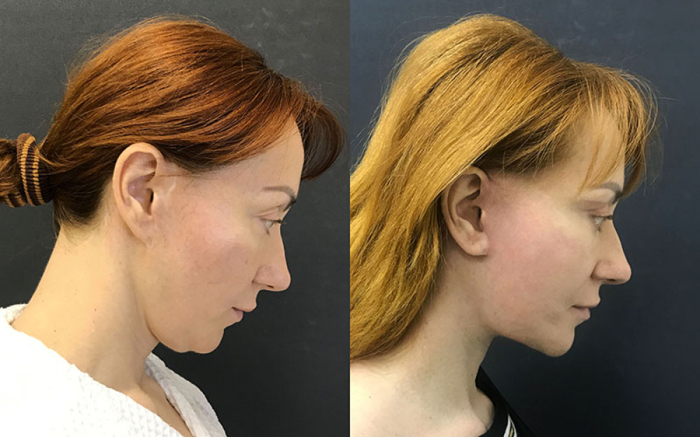 Пациентка хирурга Ованесовой О.А. до и после комплексного омоложения лица и шеи