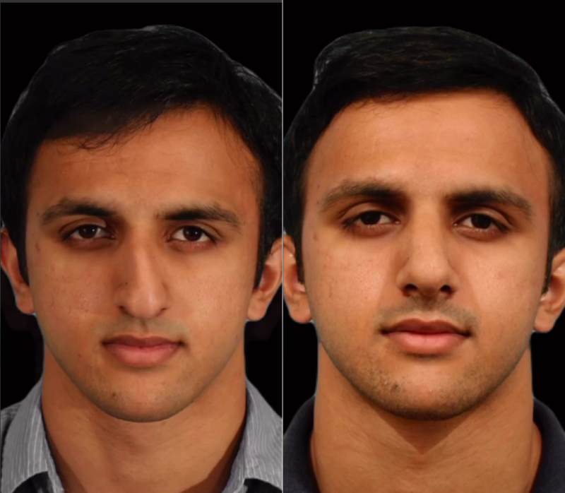 Пациент пластического хирурга Гукаса Миракяна до и после ринопластики носа