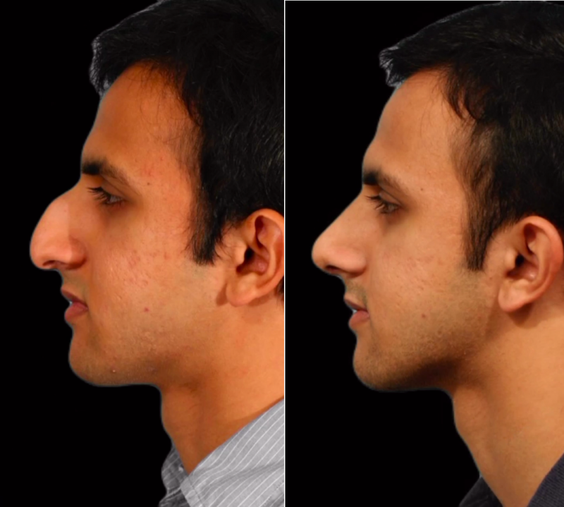 Пациент пластического хирурга Гукаса Миракяна до и после ринопластики носа