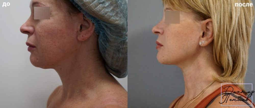 Пациентка профессора А.А. Пенаева. Выполнено омоложение лица с помощью нитевого лифтинга