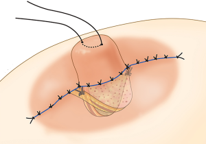 Втянутые соски