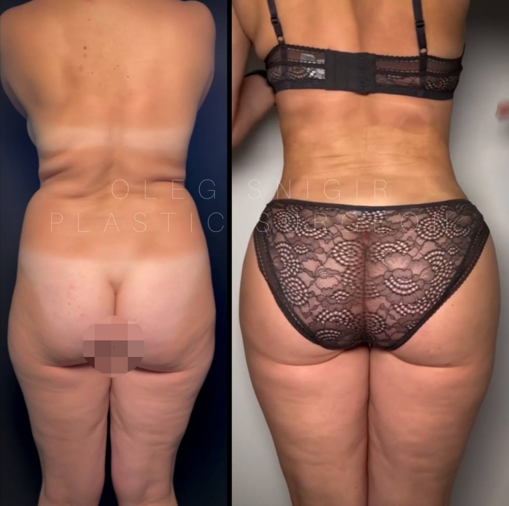 Олег Снигирь. Фото пациентки до и после липосакции