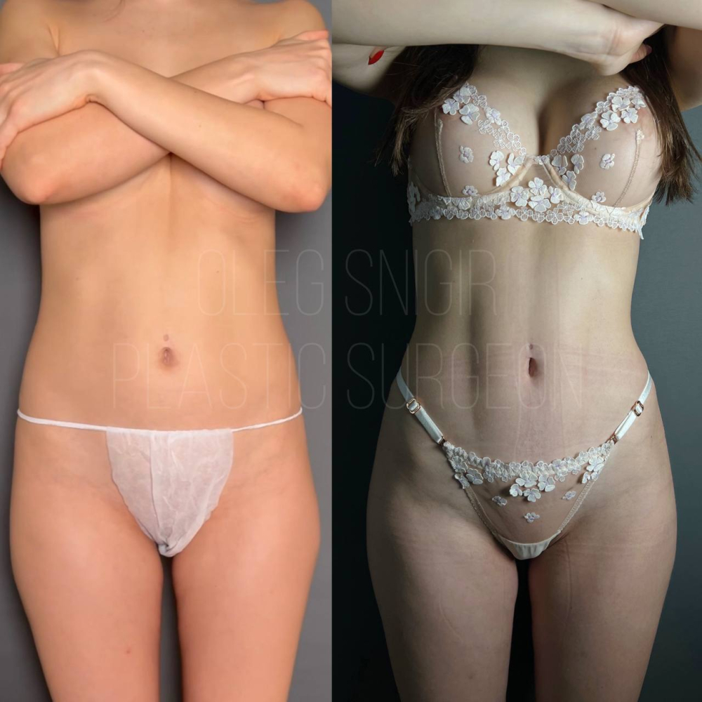 Олег Снигирь. Фото до и после липомоделирования тела и липофилинга ягодиц