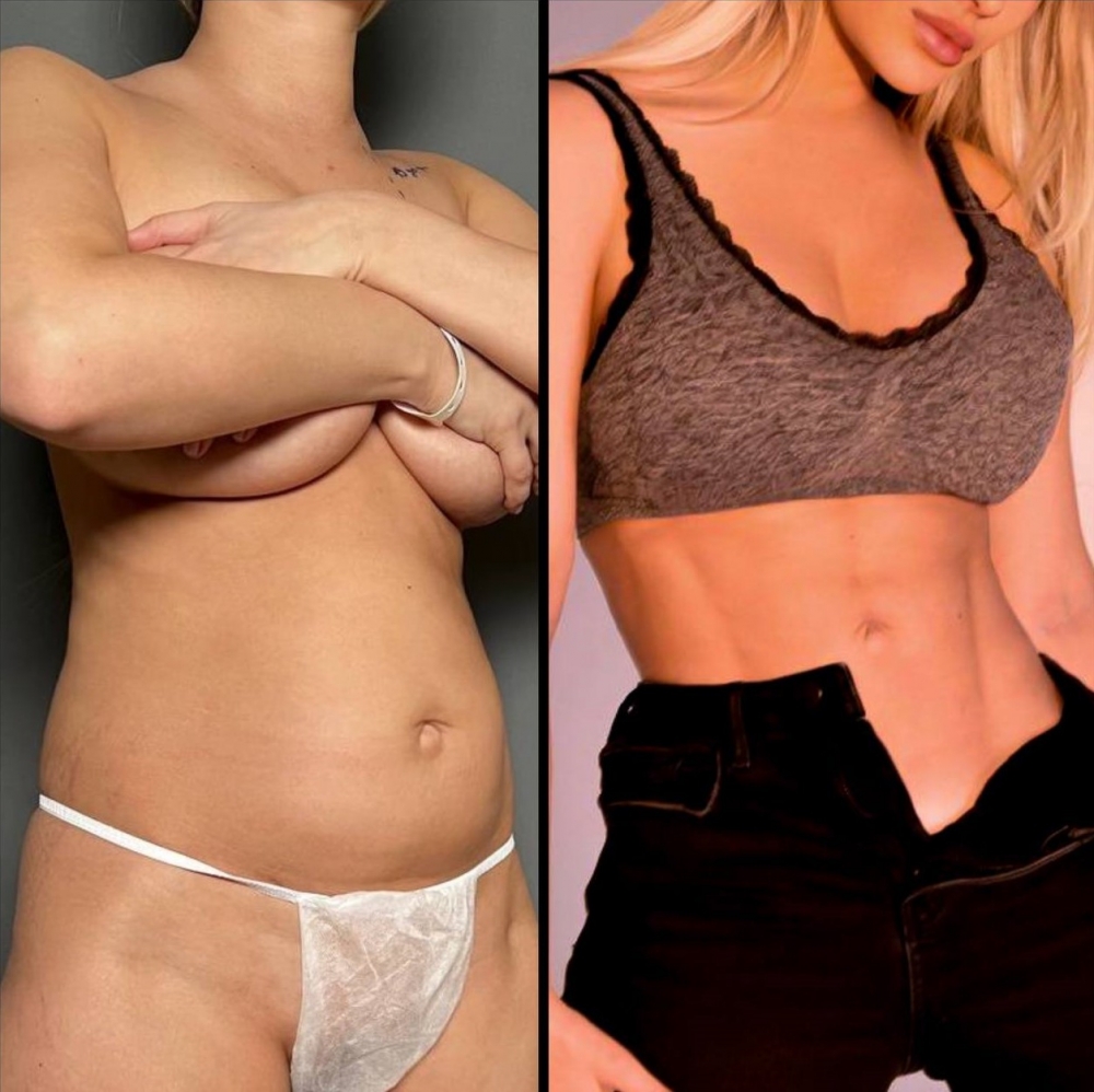 Олег Снигирь. Фото пациентки до и после комплексного липомоделирования