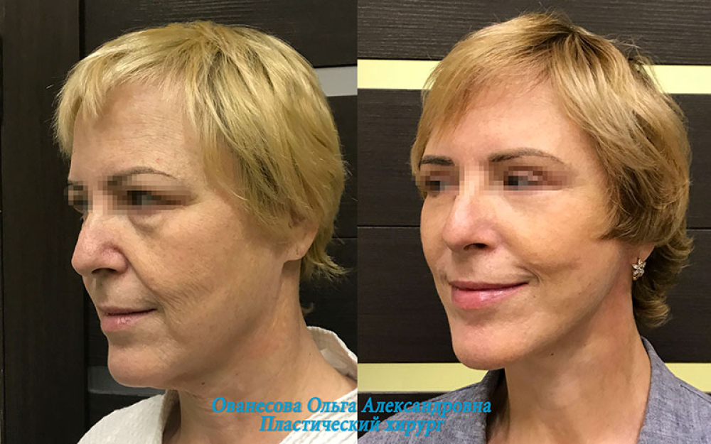 Пациентка доктора Ольги Ованесовой. Выполнен комплекс омоложения лица и шеи