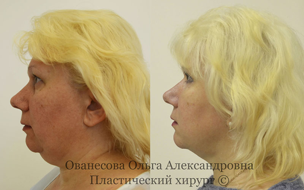 Пациентка доктора О. Ованесовой. Женщине была проведена липосакция и липомоделирование подбородочной области